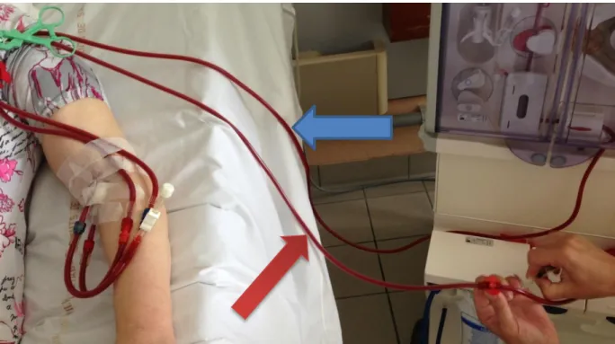 Illustration 4 : prélèvement  sur la ligne « artérielle » du circuit de dialyse