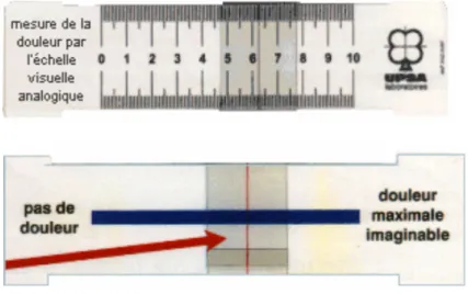 Figure 5 : Échelle visuelle analogique 