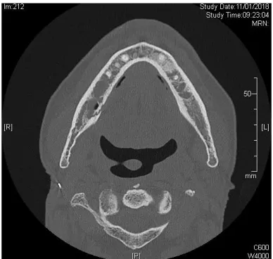 Figure 6 : Coupe transversale de scanner de mandibule montrant 2 sites d’ORN bilatéraux secteurs  prémolo-molaires 