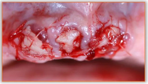 Figure 8 : Photographie après mise en place de PRF et sutures gingivales suite aux avulsions de 12-11- 12-11-21 en territoire irradié 