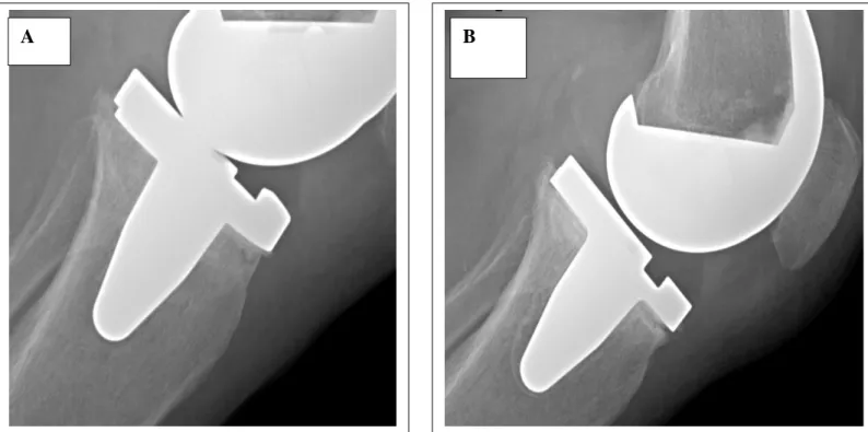 Figure 13: Radiographies du genou de face en post opératoire immédiat (A), et au recul (B)