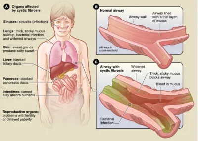 Figure 1 : Organes affectés par la fibrose kystique 