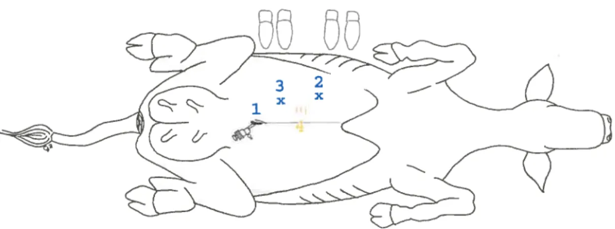 figure 7 : Position du laparoscope (1), de la pince à préhension (2. représenté par un x), du porte aiguille (3