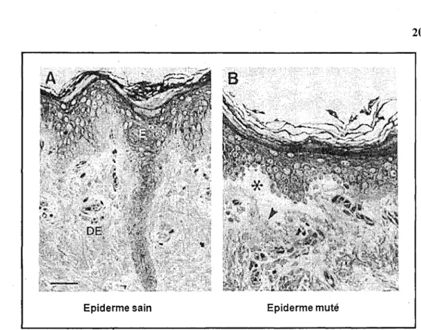 Figure 5 : Représentation schématique d'un tissu de peau normal et muté La figure ci-dessus représente en (A) un épiderme (désigné par E) sain qui est rattaché au derme désigné par (DE) et en (B) un épiderme de sujet atteint d'EBS, muté en K14 dont le phén