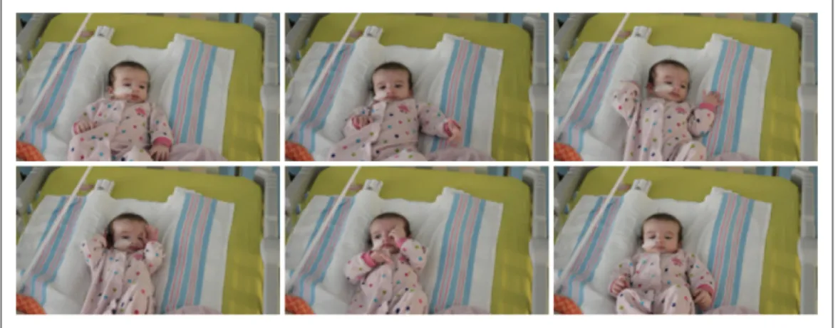 Figure 4.1 Series of frames from one recording at CHU Sainte-Justine