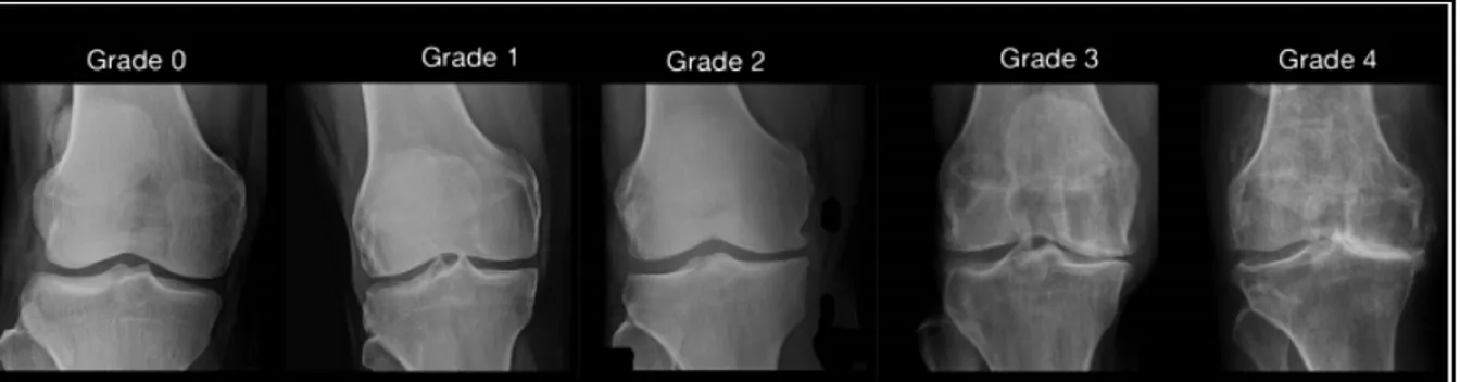 Figure 1.3 Radiographies représentant les différents grades d'arthrose   Tiré de Janvier (2016) 