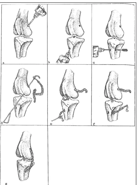 Figure 1.10 Technique chirurgicale de stabilisation d'un grasset  bovin suite à une rupture du CrCL; (a) perçage du tunnel dans 