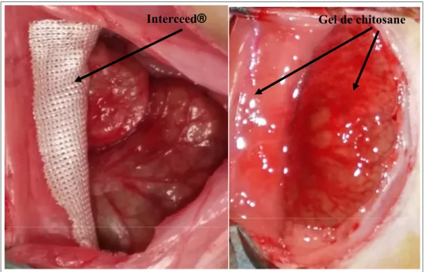 Figure 2.4: Placement du produit Interceed® (gauche) et du gel de chitosane (droite) 