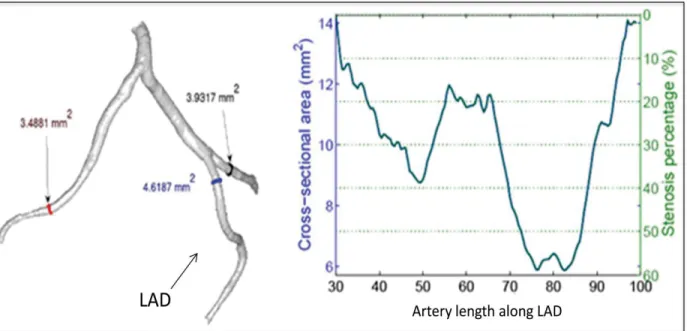 Figure 0.1 Quantification of the stenosis percentage in   a 3D reconstruction of coronary artery