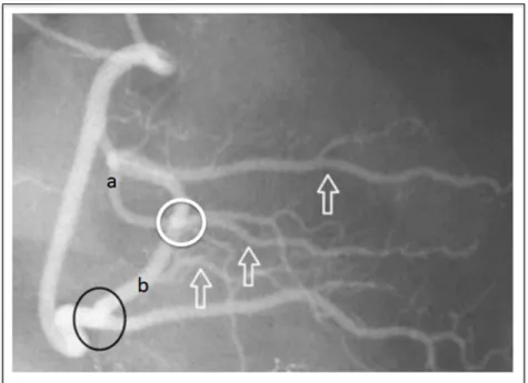 Figure 0.2 Vessel overlap and foreshortening in X-ray image. 