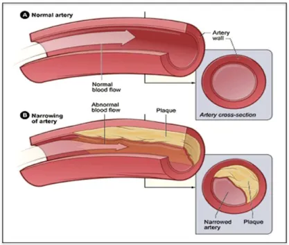 Figure 1.6 A normal artery and an artery  with plaque buildup. 