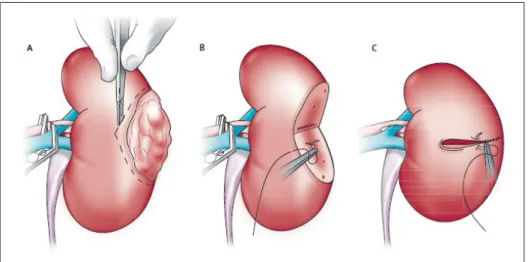 Figure 1.1 Intervention chirurgicale d’une ablation de tumeur : a) une occlusion temporaire de la vascularisation, b) résection de