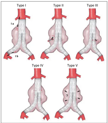 Figure 1.5  Les différents types d'endofuites après EVAR  Figure adaptée de (Greiner, Grommes et al