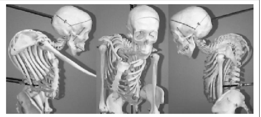 Figure 1.11  Spécimen scoliotique du tronc d'une femme décédée à l'âge de 44 ans suite à  l'insuffisance pulmonaire 