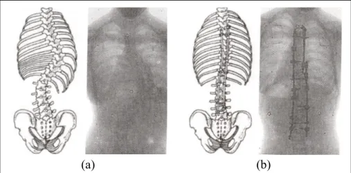 Figure 1.18  Schéma du rachis scoliotique suivi d'une radiographie  (a) représentation préopératoire (b) représentation postopératoire 