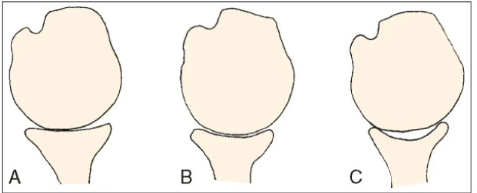 Figure 1.16 Conformité de l’articulation glénohumérale A. Surface glénoïdienne peu profonde, B