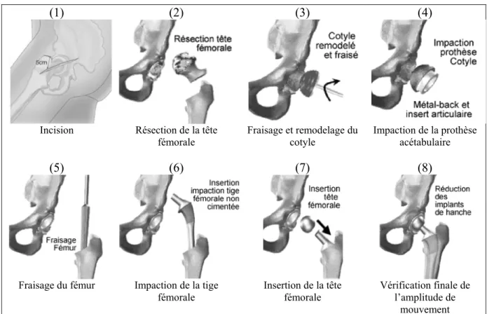 Figure 1.5 Description des grandes étapes d'une arthroplastie totale de la hanche  Adaptée de Centre Orthos (2010) 