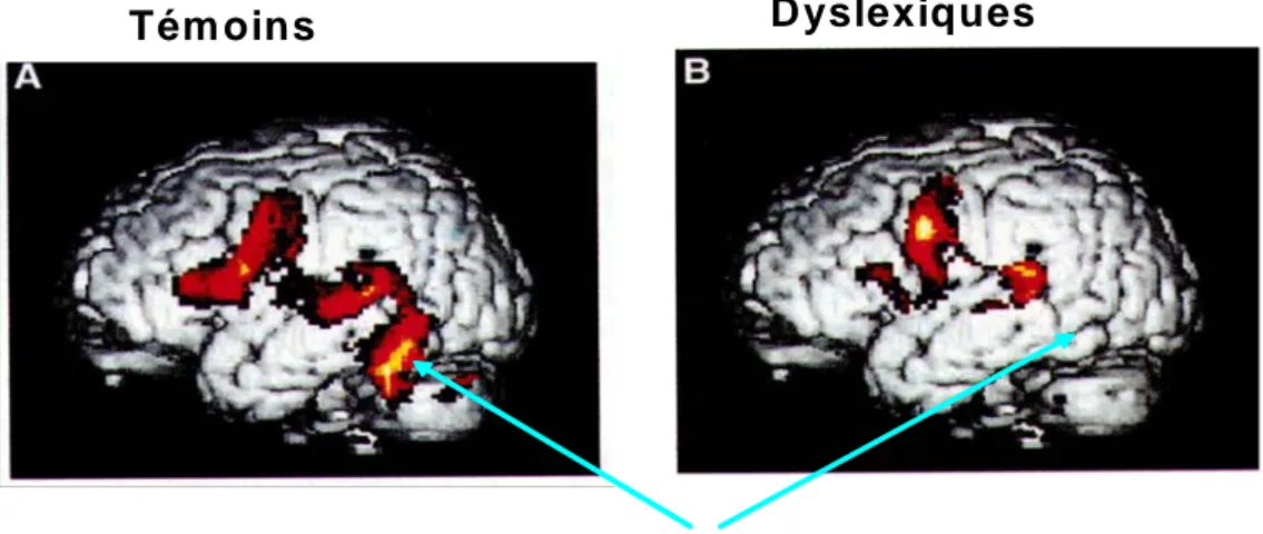 Figure 3 : Activité cérébrale pendant la lecture silencieuse des normo-lecteurs (panel A) et  des dyslexiques (panel B) en Italie, France et Angleterre (selon Paulesu et al., 2001)