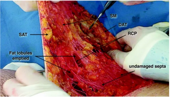 Figure 2.8: Mise en tension des RCS et des RCP au cours d’une dermolipectomie des cuisses réalisée après  lipoaspiration (cas personnel)