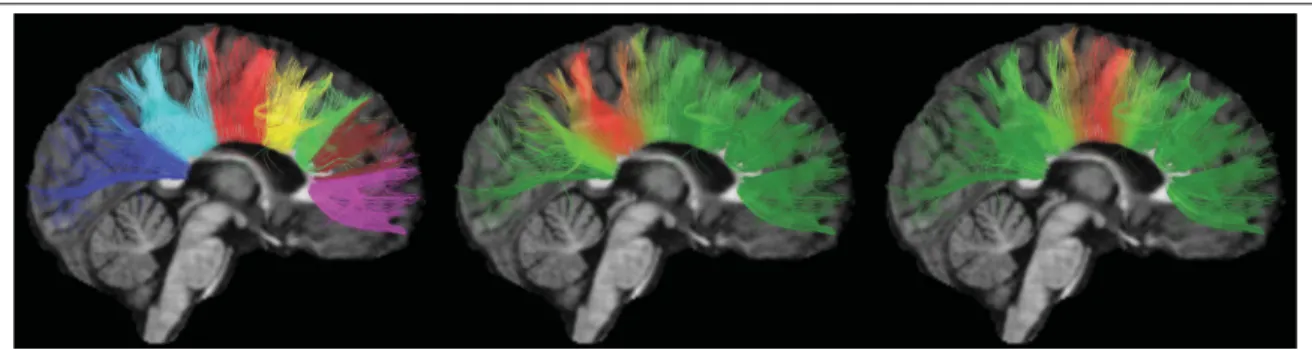 Figure 2.1 Illustrative example. Clustering of the corpus callosum by our method: hard clustering (left), and membership of each streamline to two bundles (center and right).