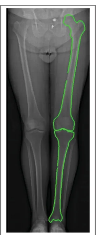 Figure 1.2 Identiﬁcation du fémur et du tibia dans le membre inférieur sur une image EOS T M en utilisant la segmentation 2D