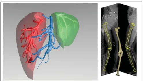 Figure 1.3 Exemple de segmentation (gauche) et reconstruction 3D (droite) Gauche : Modèle 3D obtenu par segmentation 3D du foie et de ses structures particulières