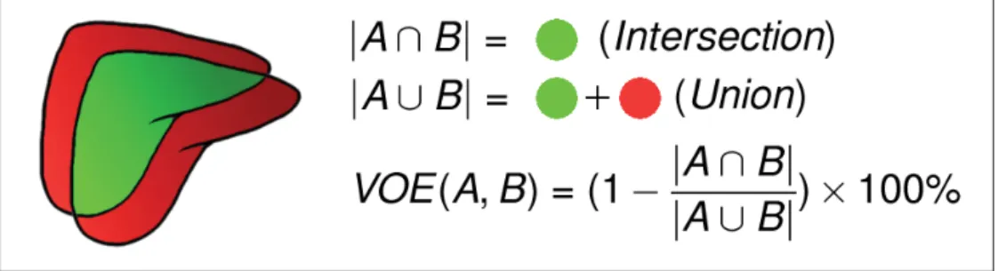 Figure 1.5 Présentation de l’indice de Jaccard en 3D, aussi appelé VOE (Volume Overlap Error)