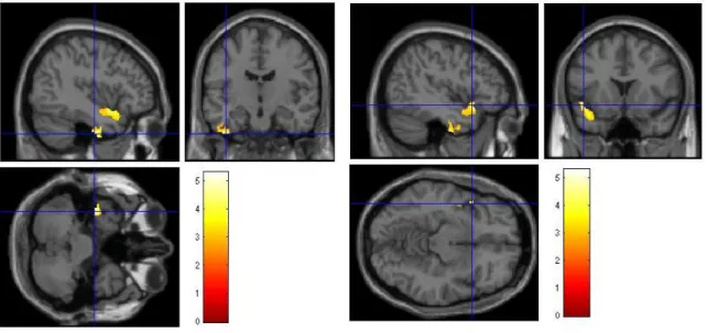 Figure  4A.  Voxel-based  Morphometry  (VBM)  results  (multiple  regression  with  age,  educational  level  and  gender as confounding variables (p&lt;0.005, FDR corrected at the cluster level p&lt;0.05) showing that semantic  memory performance (TOP 10 