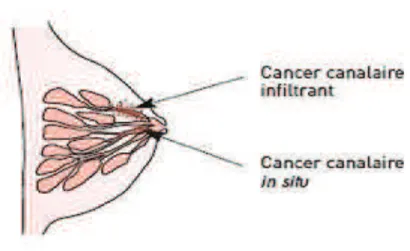 Figure 5. Cancer canalaire infiltrant et cancer canalaire in situ (FNCLCC, 2007) 