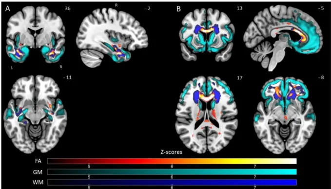 Figure 2 Patterns of voxel-based alterations in FA values, grey and white matter volumes for SD and FTD groups  of patients compared to HC