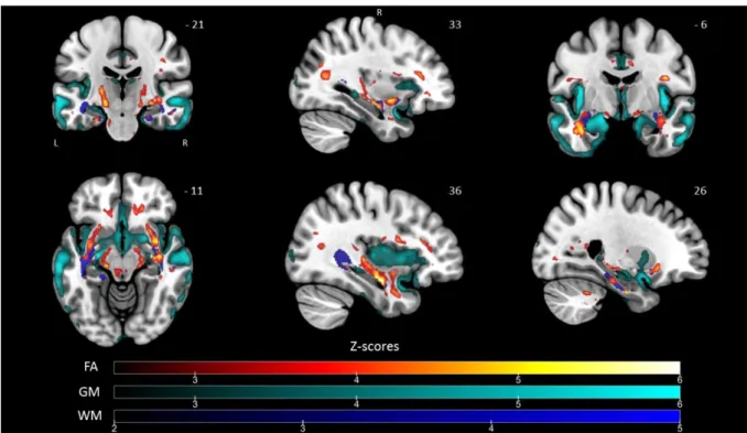 Figure 3 Pattern of voxel-based common brain alterations in FA values, grey and white matter volumes for SD  and FTD groups of patients compared to HC