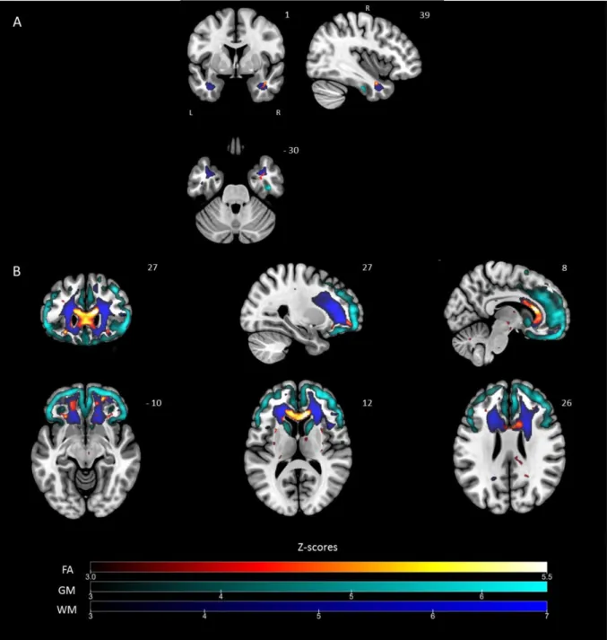 Figure 4 Pattern of voxel-based specific lower FA values, grey and white matter volumes for SD compared to  FTD group of patients