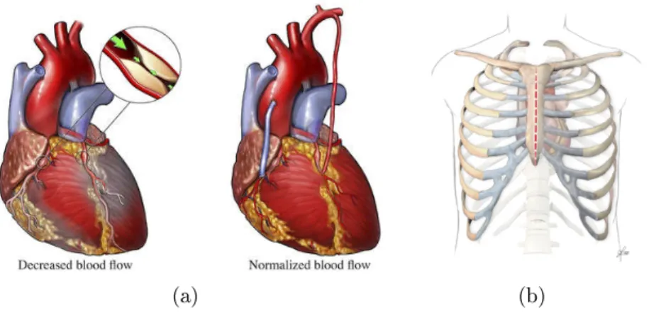 Figure I.1 : (a) Illustration of two grafts for bypassing an occluded artery. (source: