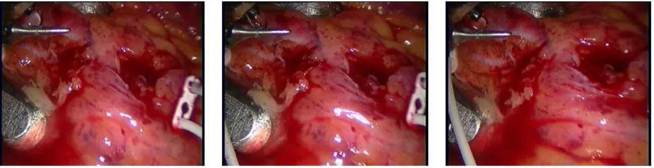 Figure II.1 : Images acquired by the left camera of a stereo endoscope during a total endoscopic coronary bypass grafting procedure using a DaVinci surgical platform.