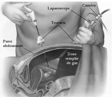 Figure 1.1 – Principes de la laparoscopie (adapté de www.danaise.com) s’imposer dans toutes les disciplines de la chirurgie abdominale : gynécologique, urologique, générale et digestive.