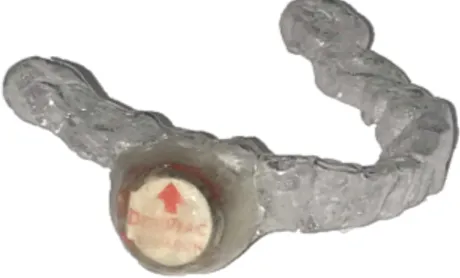 Figure 5.  Mandibular Placebo device (EssixÒ with DentitracÒ microchip).  