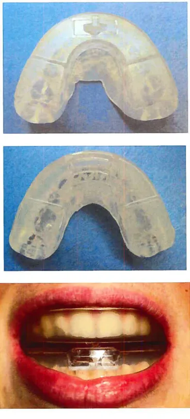 Figure 4 : The Si]encer Custom II (Silencer Products International Ltd.)