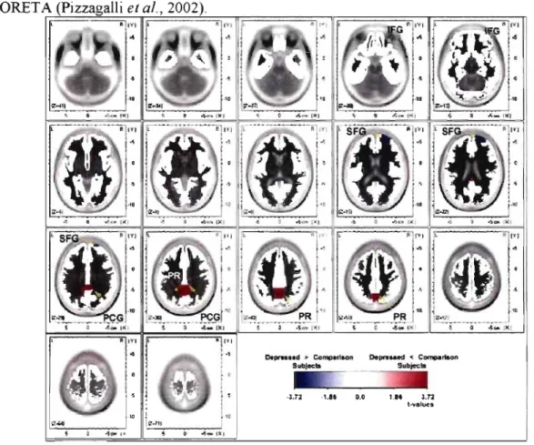 Figure 4.  Excès  d'activité Bêta3  (21-30Hz) au  niveau du gyrus frontal  inférieur et supérieur  droit  (bleu)  chez  des  individus  en  dépression  majeure,  telle  qu'estimée  par  la  méthode 