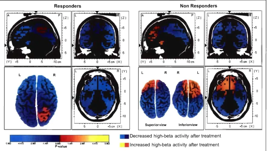 Figure  1.  Whole-brain  sLORETA  direction of changes in  absolute  power of high  -beta  (18-30Hz) activity after PNT