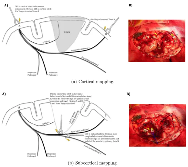 Figure 1.4: Cortical vs. subcortical stimulation. Schematic behavioural effects and uses of DES during awake brain surgery (left panels) and the corresponding intra-operative views (right panels).