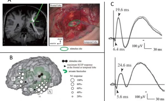 Figure 1.12: SCEP. A: Site of white matter stimulation. Electrode pair (highlighted by a green circle) was stimulated at the floor of the removal cavity (right)