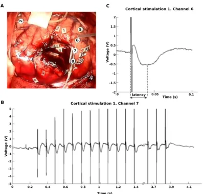 Figure 2.9: Intra-operative cortical EP induced by 10 Hz DES. A) DES is applied corti- corti-cally near electrode 6 during 3.7 s 