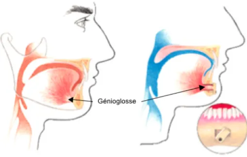 Figure 16 : Avancement du génioglosse 