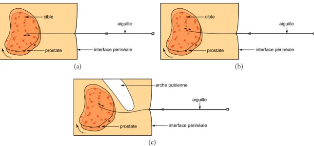 Figure 1.6 – Déformation des tissus et mouvement de la prostate induit par l’insertion de l’ai- l’ai-guille de curiethérapie