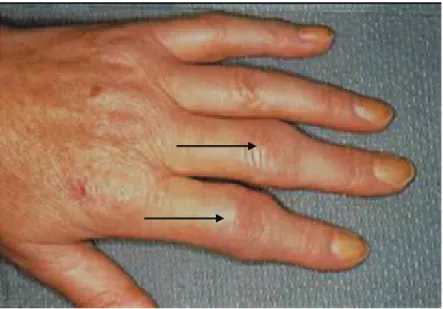 Figure  2.  Photographie  de  main  atteinte  d’une  polyarthrite  rhumatoïde.  Les  flèches  indiquent  la  présence  de  synovites   inter-phalangiennes proximales des 2 ème  et 3 ème  rayons 