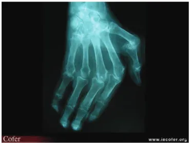 Figure  4.  Radiographie  de  face  de  la  main  droite  et  du  poignet :  déminéralisation diffuse