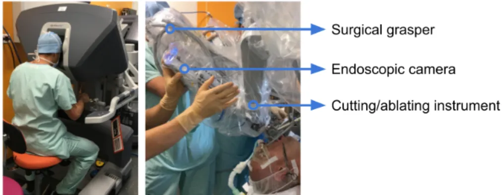 Figure 1.3 – The console (left) and three robotic arms respectively holding a surgical grasper, a cutting/ablating instrument and a 3D endoscopic camera (right) of the da Vinci ® surgical system used in transoral robotic surgery.
