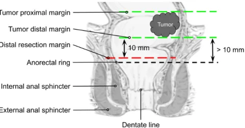 Figure 1.6 – The location of a supra-anal tumor in a rectum. Figure reproduced from Anorectum-en.svg (author: National Institute of Diabetes and Digestive and Kidney  Dis-eases (NIDDK)), used under Attribution-ShareAlike 4.0 International (CC BY-SA 4.0).