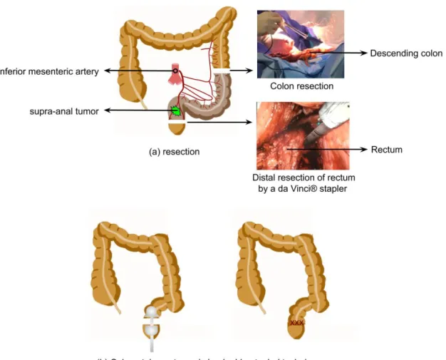 Figure 1.7 – Resection of supra-anal tumor and ultra-low colorectal anastomosis.