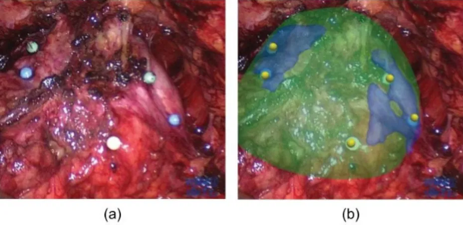 Figure 2.14 – Registration of transrectal US images to endoscopic images based on some spherical markers